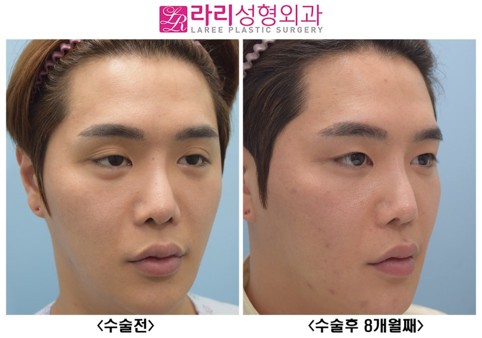 [라리성형외과] 여러겹 두꺼운 자연 쌍꺼풀 무쌍으로 풀기, 없애는 수술 관련 이미지 7