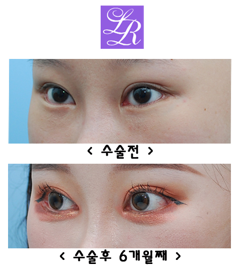 How Can You Correct Eyes With a Fierce Impression and Upturned Outer Corners? image 3