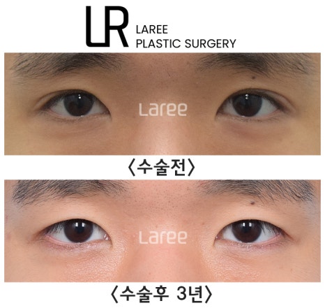 [라리성형외과] 쌍꺼풀없애는 무쌍 수술, 쌍꺼풀라인 낮추기가 아닙니다. (완전무쌍과 무쌍속쌍 그 차이) 관련 이미지 6