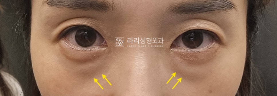 [Lari Plastic Surgery] For Bulging Under-Eyes That Eye Bag Creams / Eye Bag Patches Can’t Fix: Lower Eyelid Fat Repositioning! image 1
