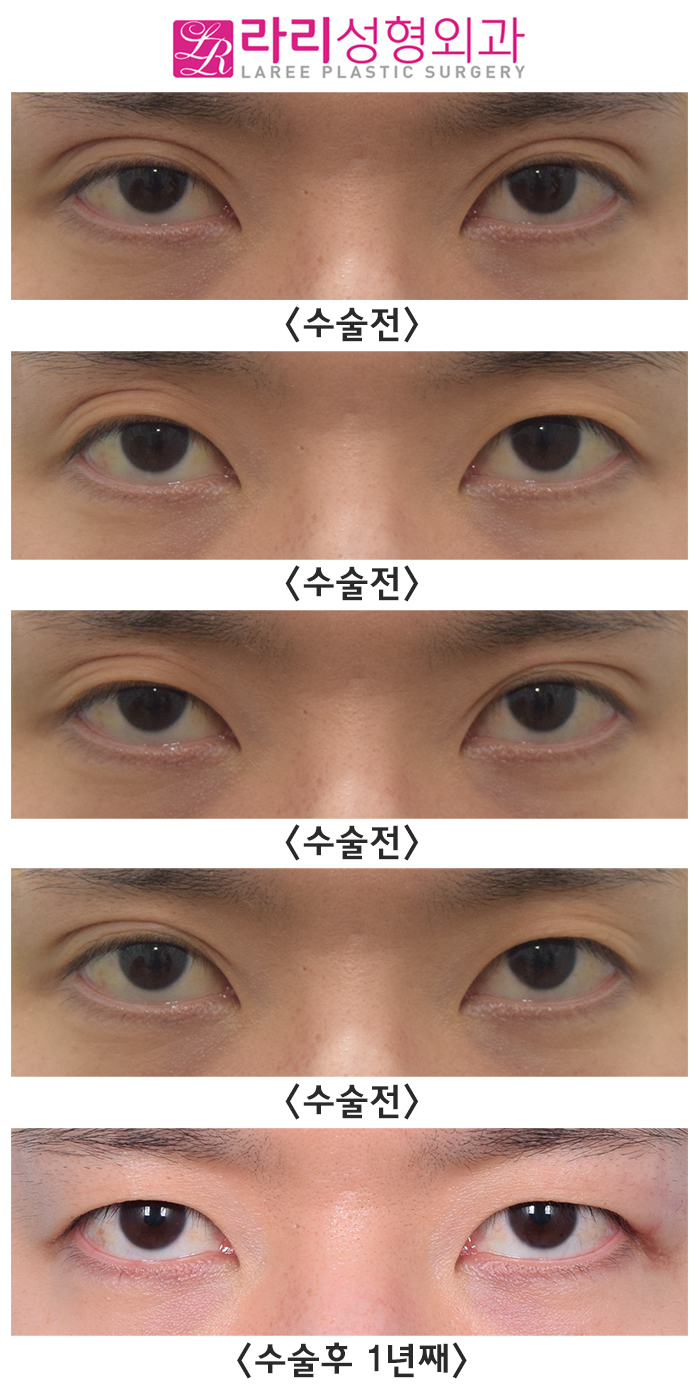 [라리성형외과] 여러 가지 쌍꺼풀 생기는 눈 무쌍으로 바꿔드립니다. 관련 이미지 5