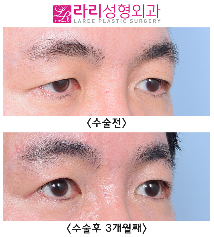 [라리성형외과] 함께해서 더 효과적인 상안검수술과 눈썹거상수술 전후 사진 관련 이미지 2