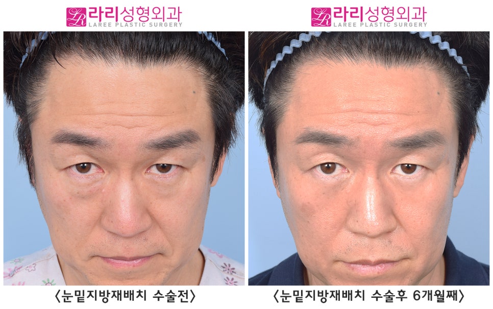 [Rari Plastic Surgery] Differences in Facial Impression Before and After Lower Eyelid Fat Repositioning Surgery in Middle Age image 2