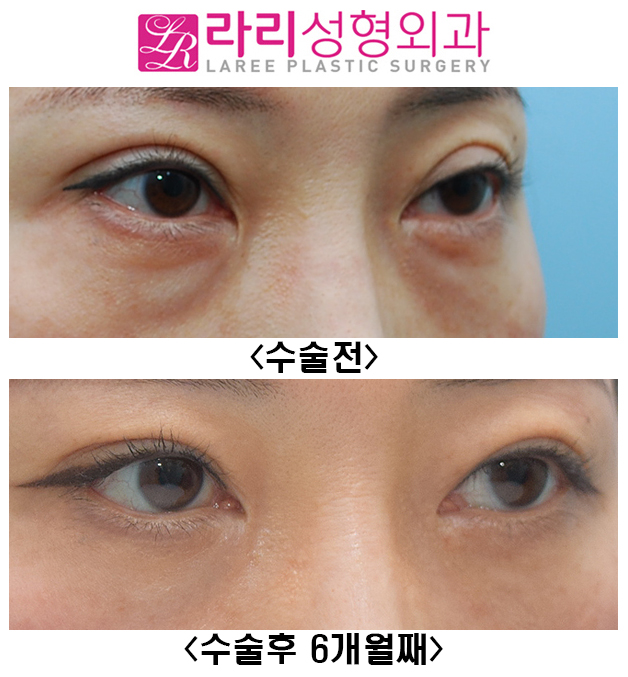 [라리성형외과] 쌍꺼풀재수술, 앞트임재수술, 눈밑지방재배치재수술 전후사진 관련 이미지 2