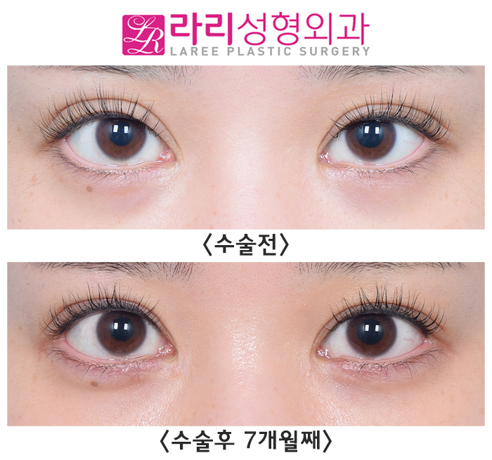 [라리성형외과] 한 번에 한 여러 가지 눈 수술 경과 (쌍꺼풀재수술, 앞트임복원, 뒤트임수술, 눈밑지방이식) 관련 이미지 1