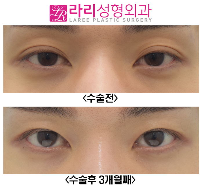 [라리성형외과] 졸려 보이는 자연쌍꺼풀, 아웃라인을 무쌍에 가까운 속쌍꺼풀로 또렷하게 만들기 관련 이미지 1