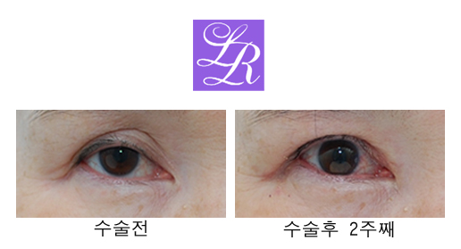 쌍꺼풀 푸는 수술/ 없애기 차이점은? 관련 이미지 1