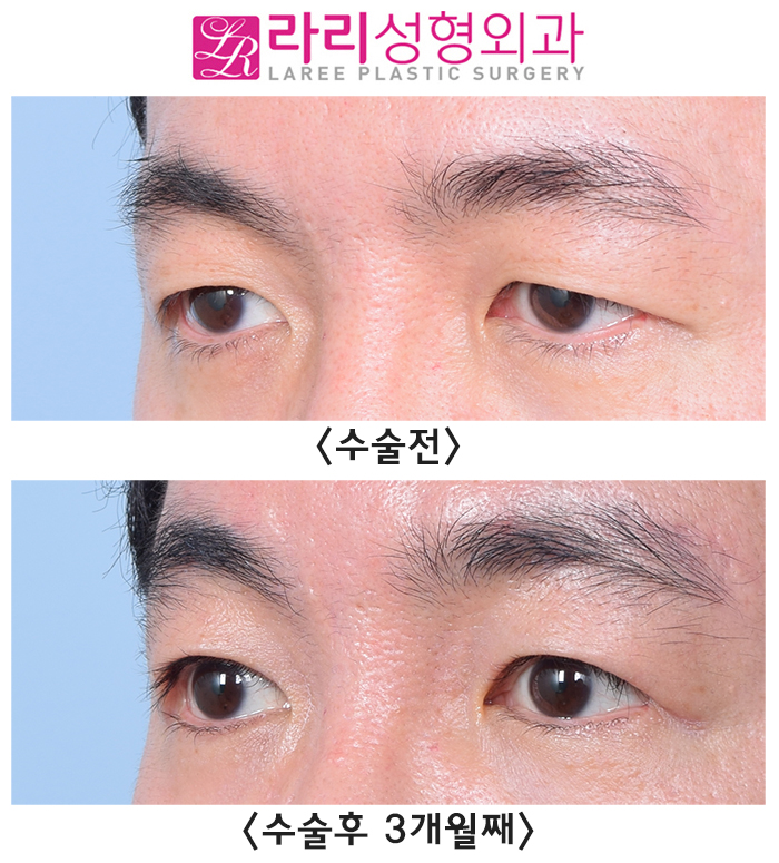 [라리성형외과] 함께해서 더 효과적인 상안검수술과 눈썹거상수술 전후 사진 관련 이미지 3