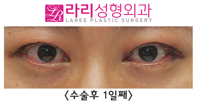 [라리성형외과] 쌍꺼풀없애는수술 단기 회복부터 장기 경과까지 관련 이미지 2