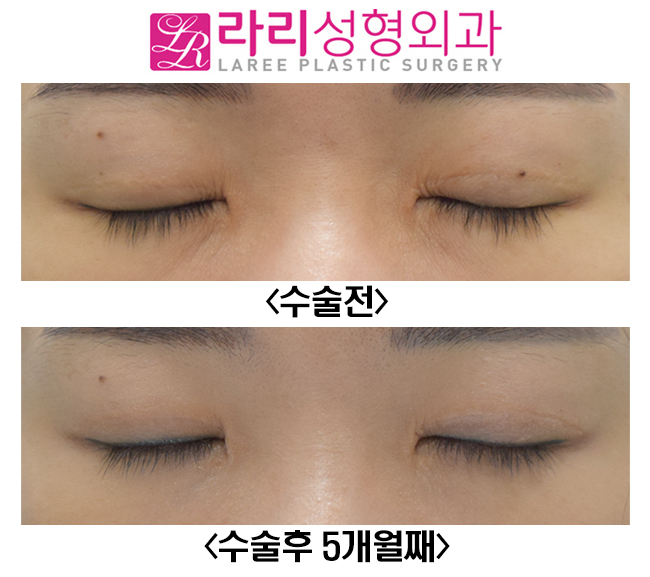 [라리성형외과] 눈매교정이 함께 필요한 쌍꺼풀재수술, 비대칭 눈교정 전후사진 관련 이미지 4
