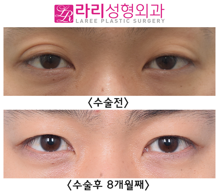 [라리성형외과] 쌍꺼풀없애는수술, 남자라면 꼭 고려해 보세요. 관련 이미지 1