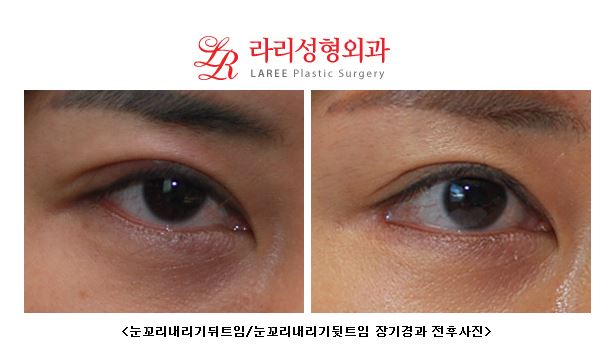 Lateral Canthoplasty for Lowering the Outer Eye Corners / Outer Corner Lowering Revision Canthoplasty: 2 Years After Surgery image 2