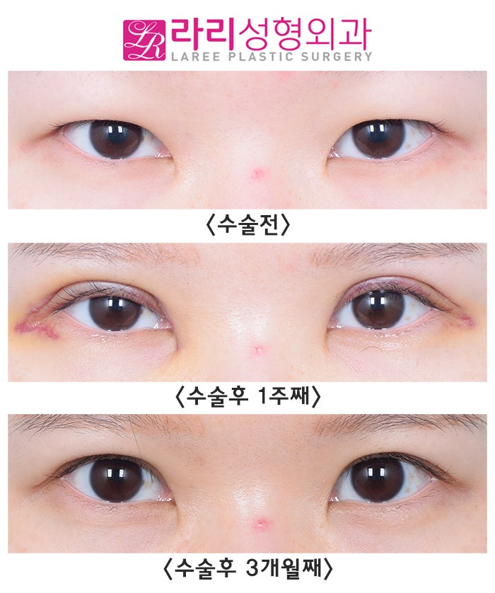 [Lari Plastic Surgery] The Recovery Process After Incisional Ptosis Correction: Don’t Be Surprised, Just Wait! image 3