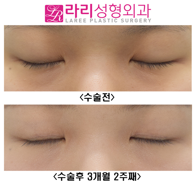 [라리성형외과] 여자도 무쌍눈매교정이 어울릴까? 관련 이미지 2