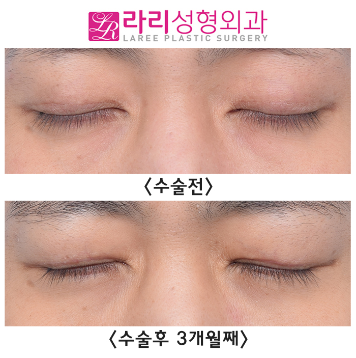 [Lari Plastic Surgery] Bulging Eyes? Sunken Eyes? Smoother with Fat Grafting and Double Eyelid Removal image 4