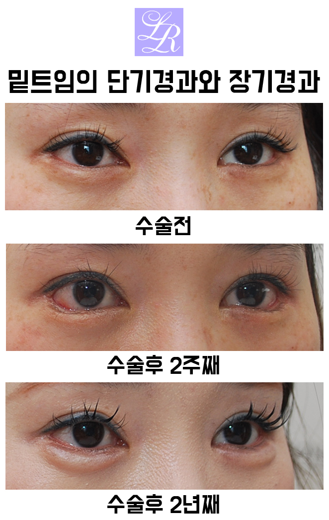 If You Want an S-Line Under Your Eyes, Try Lower Eye Widening image 12