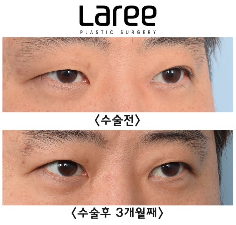 [Lari Plastic Surgery] A Collection of Various Surgeries for Double Eyelids image 10