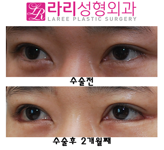 비절개눈매교정술과 뒤트임재수술 함께 한다면 관련 이미지 4