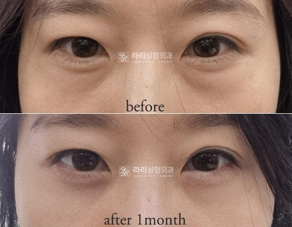 [Lari Plastic Surgery] For Bulging Under-Eyes That Eye Bag Creams / Eye Bag Patches Can’t Fix: Lower Eyelid Fat Repositioning! image 3