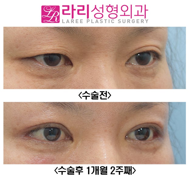 [라리성형외과] 자연스러운 절개눈매교정과 함께한 눈꼬리내리기뒤트임 수술전후 관련 이미지 5