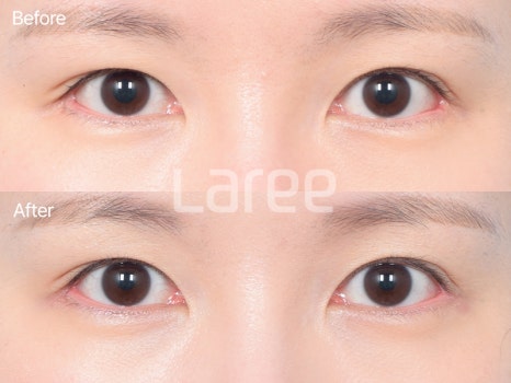 [LaLi Plastic Surgery] Outer Canthus Lowering Surgery, If It’s a Revision Surgery, It Must Be Done at a Place That Does It Well. image 7