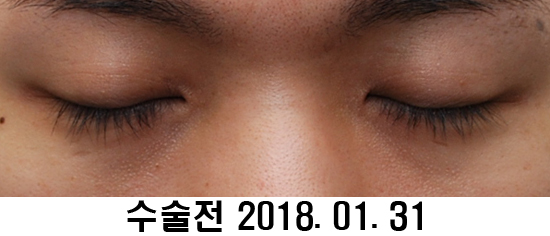 Before and After: Sharper Male Eye Correction (feat. Video) image 3