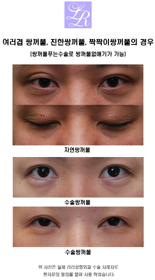 Double Eyelid Removal Surgery: Delicate Dissection Is Important! image 1