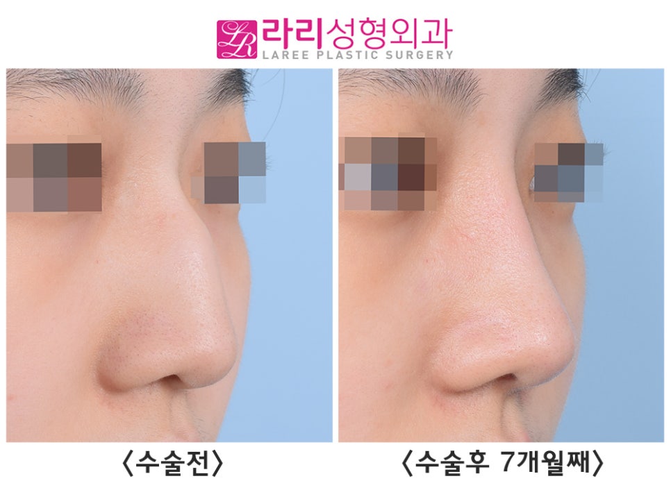 [라리성형외과] 선천성 매부리코, 첫코성형으로 고민하지 말고 매끄럽게 바꾸자 관련 이미지 1