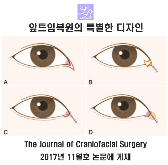 Medial Canthoplasty Revision: Surgery for Severe Medial Canthal Scarring image 2