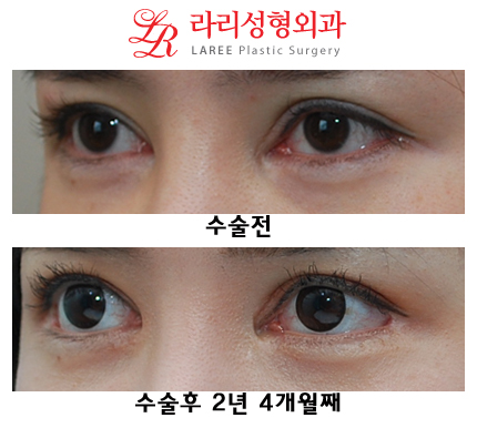 Total Eye Plastic Surgery Care (Ptosis Revision Surgery, Epicanthoplasty Restoration, Revision Lateral Canthoplasty) image 2