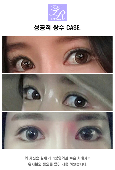 짝눈 수술 - 짝짝이 눈 교정하기 관련 이미지 8