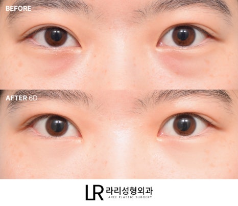 [라리성형외과] 하루(1DAY) 투자로 예뻐지는 라리성형외과의 퀵 눈밑지방재배치수술 관련 이미지 3