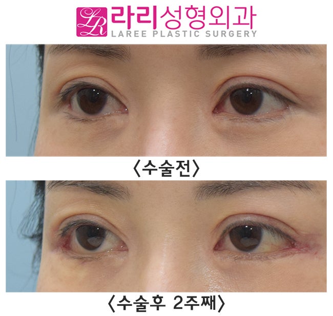 [라리성형외과] 뒤트임수술 단기경과, 결막부종 없이 회복이 빠 경우도 있어요. 관련 이미지 3