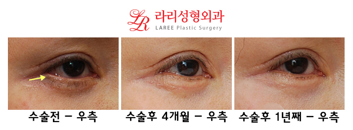 Complications of Lower Blepharoplasty: Ectropion Correction (Senile, Traumatic, Iatrogenic) image 7
