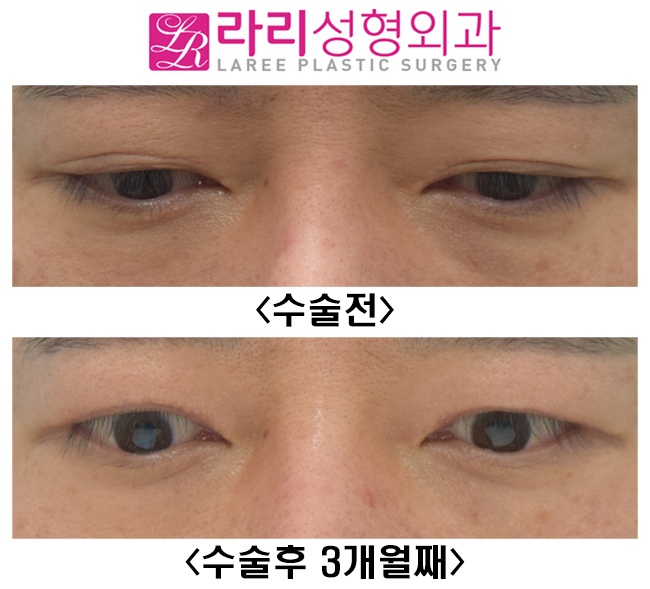 [Lari Plastic Surgery] Surgery to remove double eyelids only removes the double eyelids. image 2
