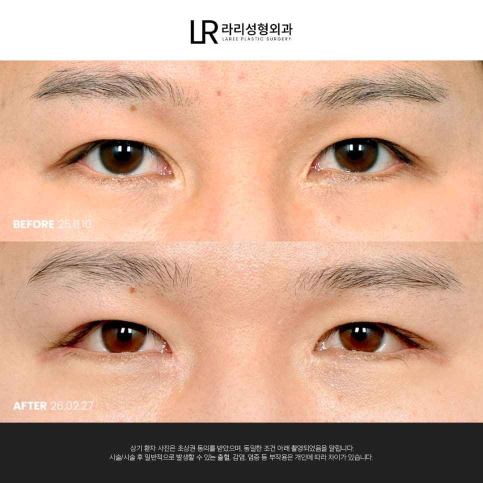 [라리성형외과] 여러 모양의 앞트임 흉터가 고민이라면 관련 이미지 3