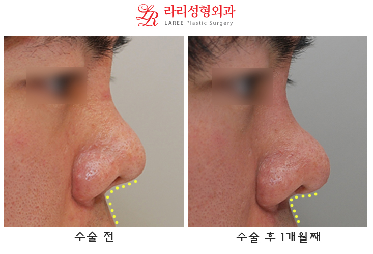 Correction of Upturned Nose and Contracted Nose, Revision Rhinoplasty Using Autologous Tissue (feat. Ear Cartilage) image 7