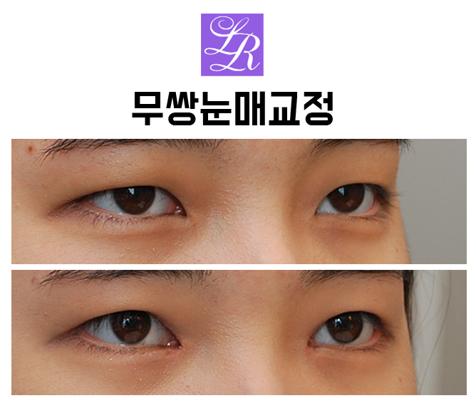 자연스러운 안검하수 교정  -무쌍눈매교정, 비절개눈매교정 관련 이미지 3