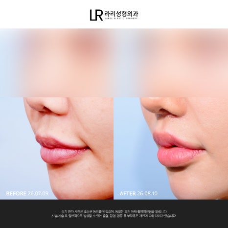 [라리성형외과] 사진 찍으면 유독 길어 보이는 인중, 인중축소로 달라질 수 있을까? 관련 이미지 10