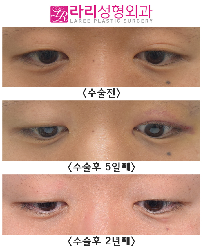 [Lari Plastic Surgery] Double Eyelid Removal: Long-Term Before-and-After Photos of Surgery on Only One Side image 1