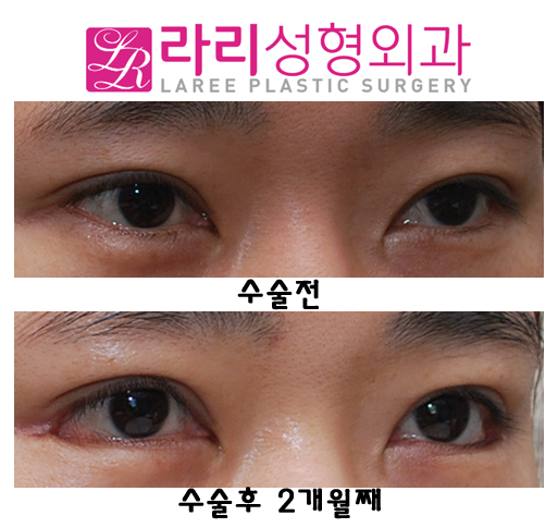 비절개눈매교정술과 뒤트임재수술 함께 한다면 관련 이미지 3