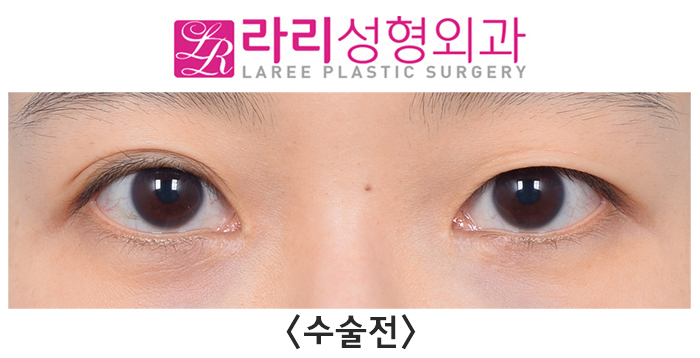 [Lari Plastic Surgery] Correcting Uneven Eyes with Non-Incisional Revision Surgery image 1