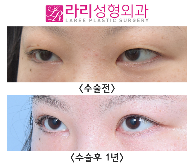 [라리성형외과] 절개눈매교정 자연스러운 인라인 속쌍 + 눈꺼풀 패인 흉터교정 관련 이미지 2