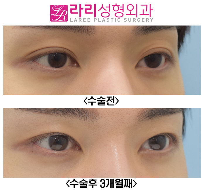 [라리성형외과] 졸려 보이는 자연쌍꺼풀, 아웃라인을 무쌍에 가까운 속쌍꺼풀로 또렷하게 만들기 관련 이미지 2