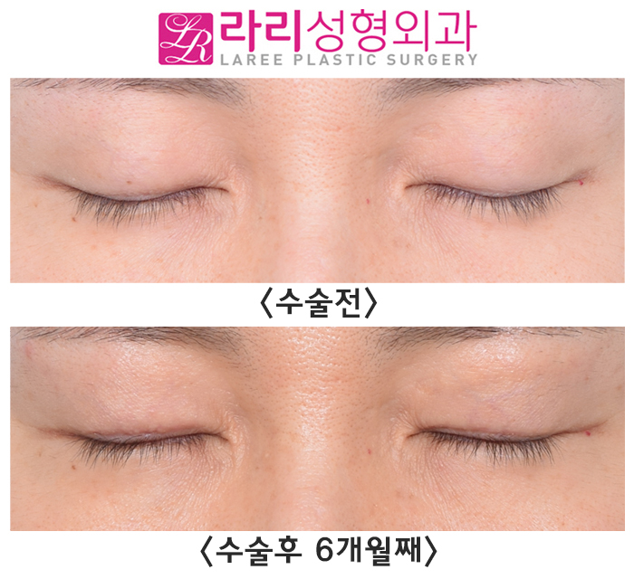 [라리성형외과] 절개쌍꺼풀없애기 + 윗눈꺼풀지방이식, 6개월 차 수술 전후 경과 사진 관련 이미지 4