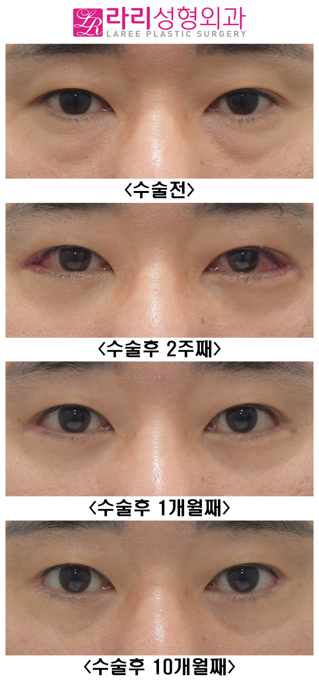 [라리성형외과] 남자 눈꼬리내리기 뒤트임수술 후 변화 관련 이미지 2