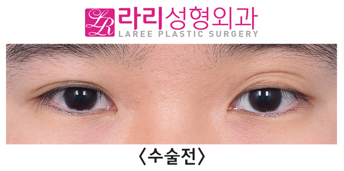 [Lari Plastic Surgery] Correcting a Severe Uneven Eye with Double Eyelid Removal Surgery image 1