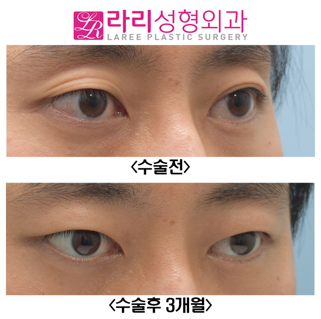 [라리성형외과] 쌍꺼풀없애기와 함께 한 윗눈꺼풀 패임 교정, 눈두덩이(Roof) 지방이식수술 전후사진 관련 이미지 3