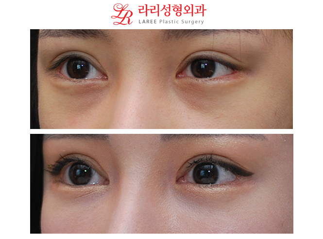 왼쪽 눈매교정재수술, 눈꼬리내리기뒤트임재수술, 눈밑지방제거 수술후 장기경과 전후사진☆ 관련 이미지 2