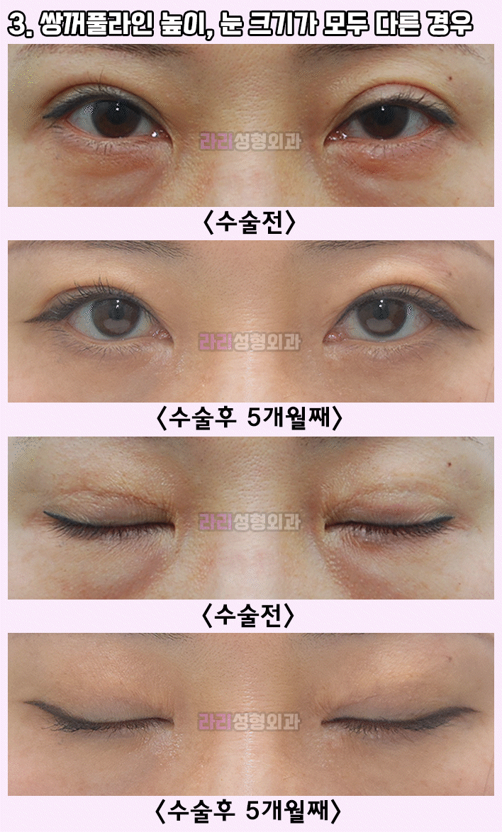 [라리성형외과] 쌍수후짝눈,  선천성짝눈 - 짝짝이쌍꺼풀의 비대칭 교정을 위한 눈성형 방법 관련 이미지 3